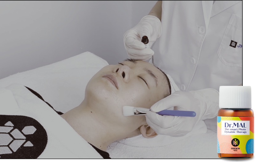 application of dr mal solution before performing pdt treatment for acne relief